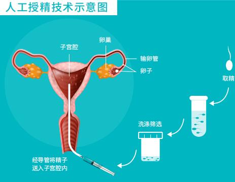 人工授精的过程与费用