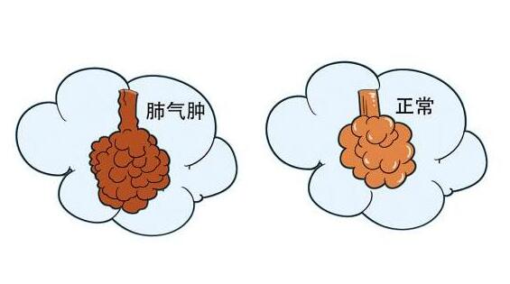 什么是肺气肿?肺气肿严重吗?