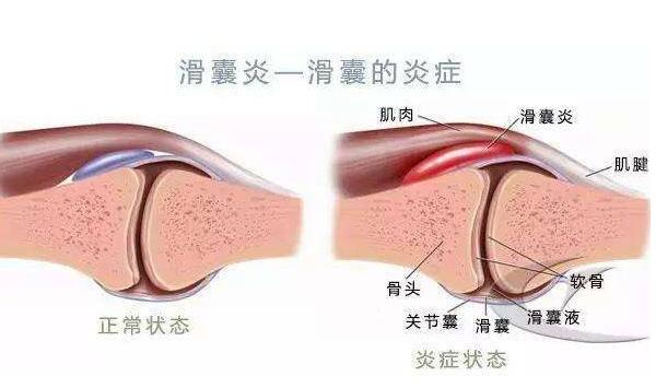 滑囊炎的症状是什么