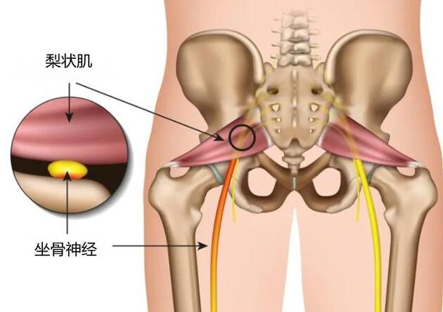 梨状肌综合征的最佳治疗方法