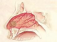 鼻血管瘤