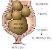 进食障碍