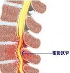 胸椎管狭窄