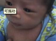小儿甲状腺功能亢进