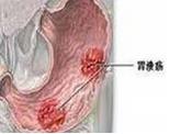 小儿消化性溃疡