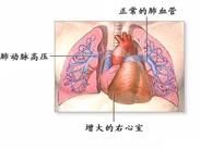 心肌病 心肌病
