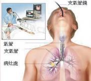 呼吸道异物