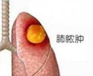 急性肺脓肿
