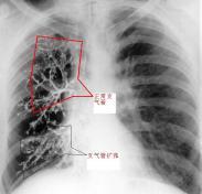 急性细支气管炎