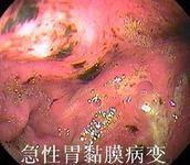 急性胃粘膜病变 急性胃粘膜病变