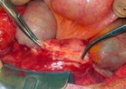 继发性化脓性腹膜炎 继发性化脓性腹膜炎