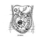 急性腹膜炎