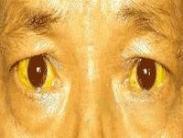 吉尔伯特综合征