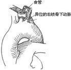 畸形性吞咽困难 畸形性吞咽困难