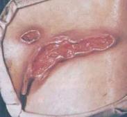 化脓性汗腺炎 化脓性汗腺炎