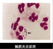 脑膜炎奈瑟菌肺炎 脑膜炎奈瑟菌肺炎