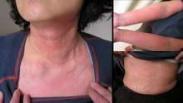 肝-甲状腺综合征