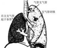 小儿单侧肺异常透亮综合征 小儿单侧肺异常透亮综合征