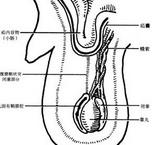 斜疝