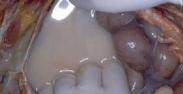 特发性腹膜后纤维化