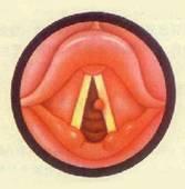 食管损伤 食管损伤
