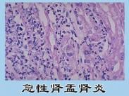 急性肾盂肾炎