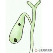 陶瓷样胆囊 陶瓷样胆囊