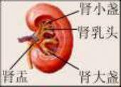 肾盏憩室