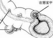 憩室病