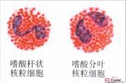 嗜酸性粒细胞增多症