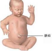 脐膨出-巨舌-巨大躯体综合征 脐膨出-巨舌-巨大躯体综合征