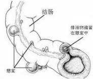 消化道憩室病