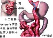 吻合口溃疡