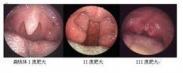 阻塞性睡眠呼吸暂停综合征 阻塞性睡眠呼吸暂停综合征