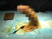 阴茎纤维性海绵体炎 阴茎纤维性海绵体炎