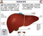 营养不良性肝硬化