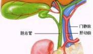 胰胆管合流异常综合征