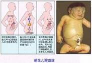 新生儿肝脾肿大 新生儿肝脾肿大