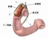 慢性胆囊炎 慢性胆囊炎