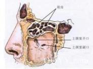 筛窦恶性肿瘤 筛窦恶性肿瘤