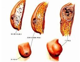 乳腺癌