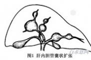 先天性胆管扩张症