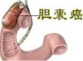 胆囊癌 胆囊癌