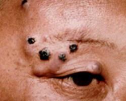 大汗腺癌