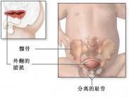 尿道上裂