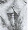 乳头状小汗腺腺瘤