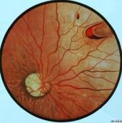 黄斑裂孔性视网膜脱离