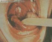 淋球菌性腹膜炎