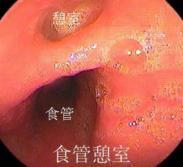 膈上食管憩室