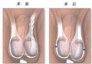 睾丸扭转